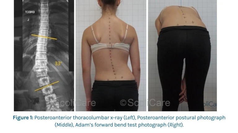 girl with scoliosis before and after