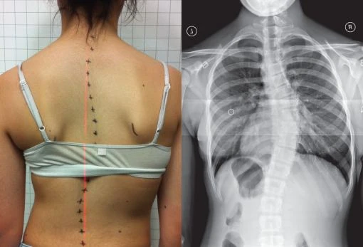 picture of scoliosis back and picture of scoliosis xray