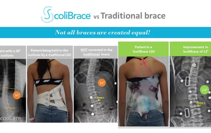 scolibrace vs traditional brace