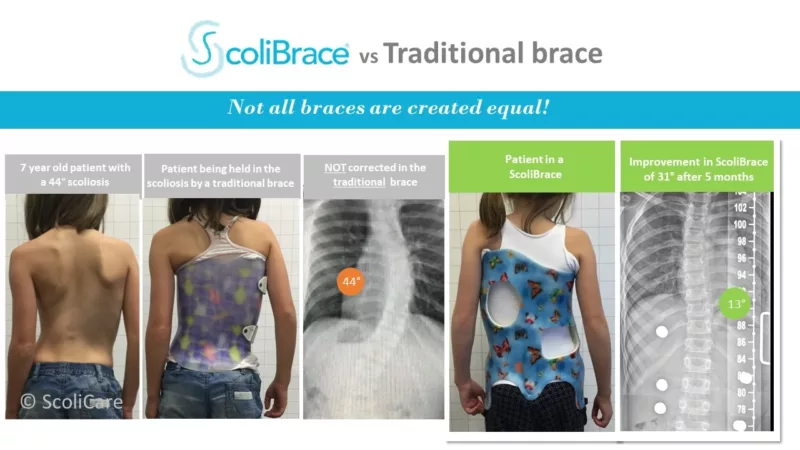 scolibrace vs traditional brace2